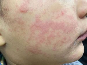 <div>Experts call for a measles ‘immunization action plan’ in Ontario</div>